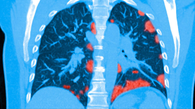 041720_dc_covid-lungs_feat-800x450.jpg