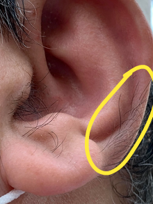 220px-Long_ear_hair_on_man__01.png