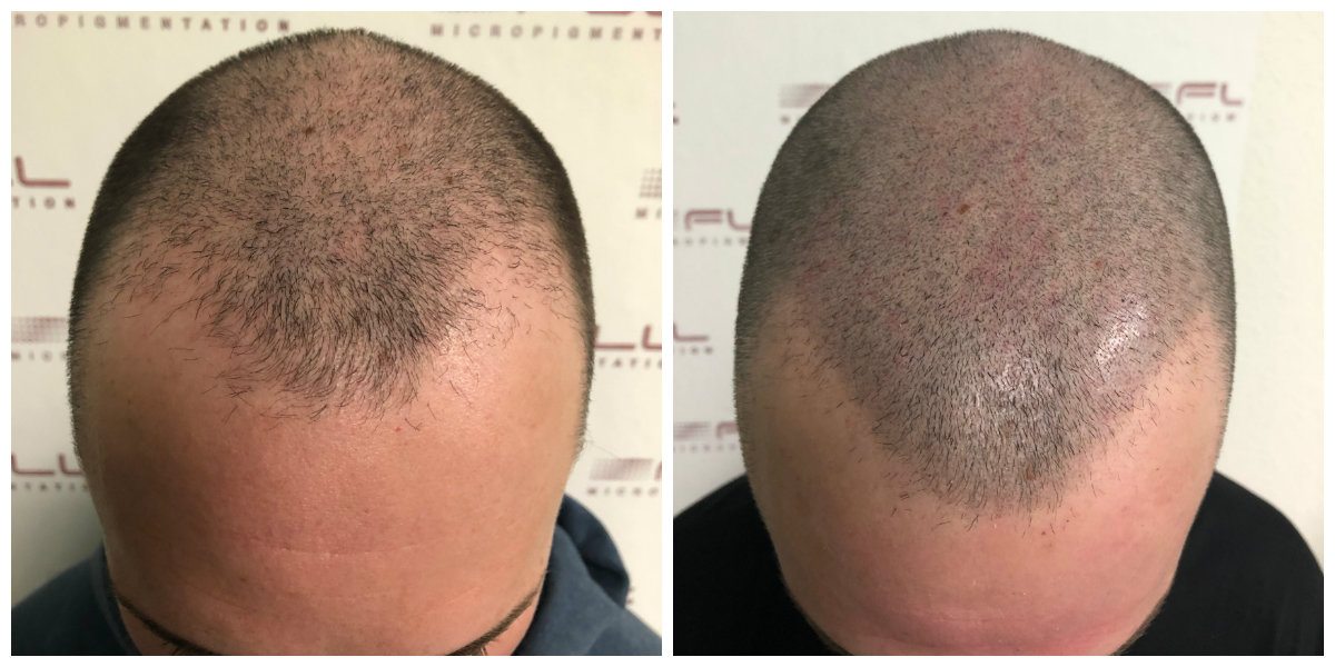 Alex-Scalp-Micropigmentation-Before-and-After-2.jpg