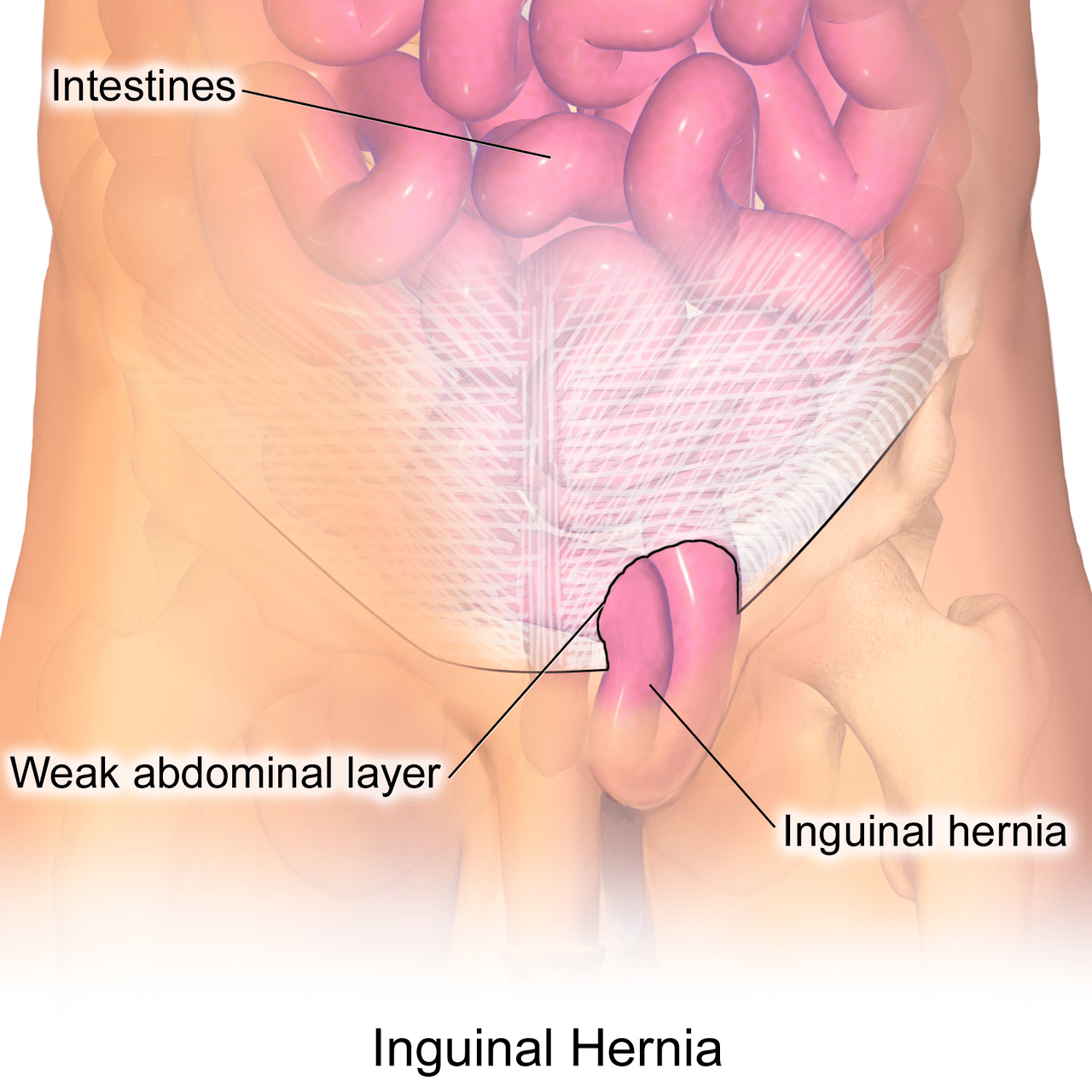 Blausen_0560_InguinalHernia-min.png
