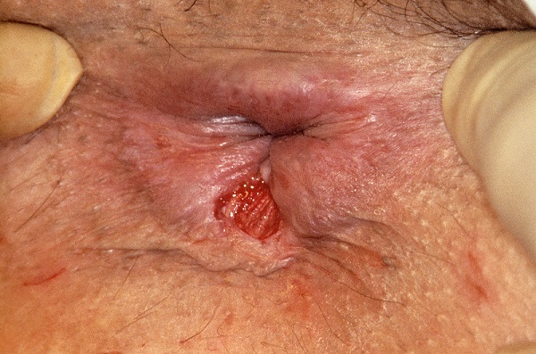c0044711-anal-fissure-science-photo-library-high.jpg