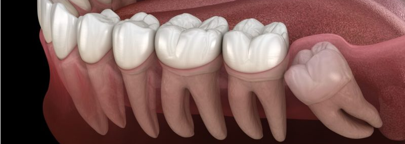 causes-of-wisdom-tooth-pain-dentistry-on-coolum.png