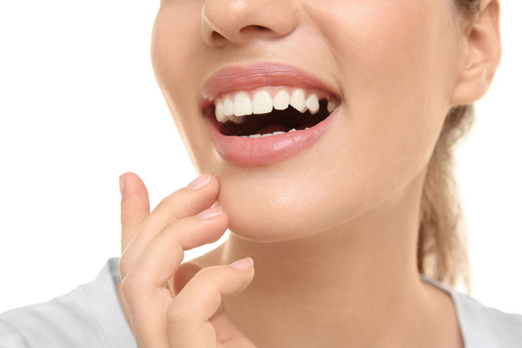 Choice-dental-missing-tooth-1024x683.jpg