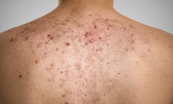 Do-you-want-to-know-how-to-get-rid-of-acne-scars-on-the-back-1437486843-600x360.jpg