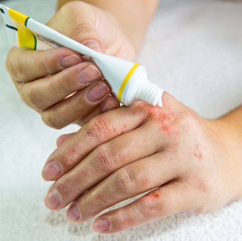 eczema-1600224489.jpg
