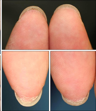 Fingers-showing-adherence-of-the-distal-portion-of-the-nail-bed-to-the-ventral-surface-of.jpg