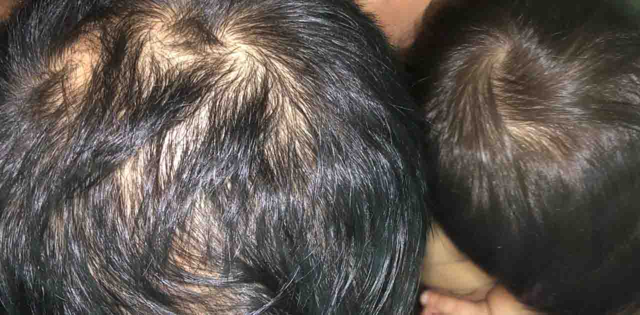 hair loss.jpg