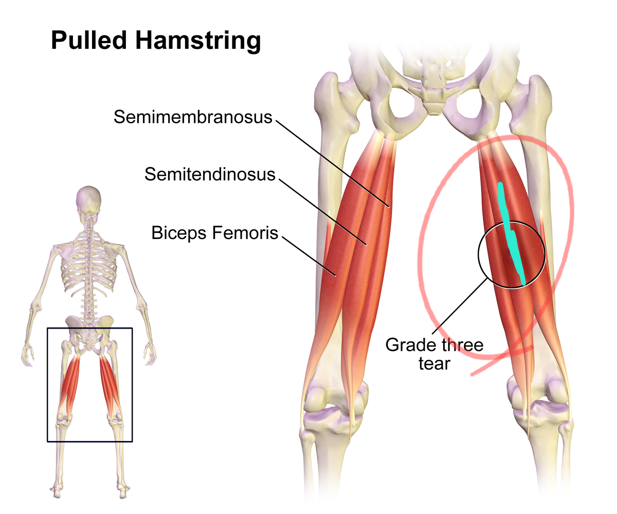 Hamstring-Strain.png