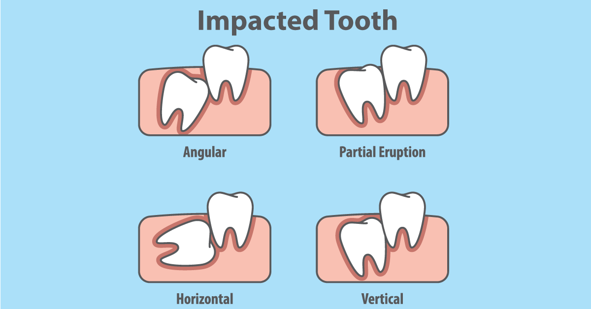 impacted-tooth-og.png