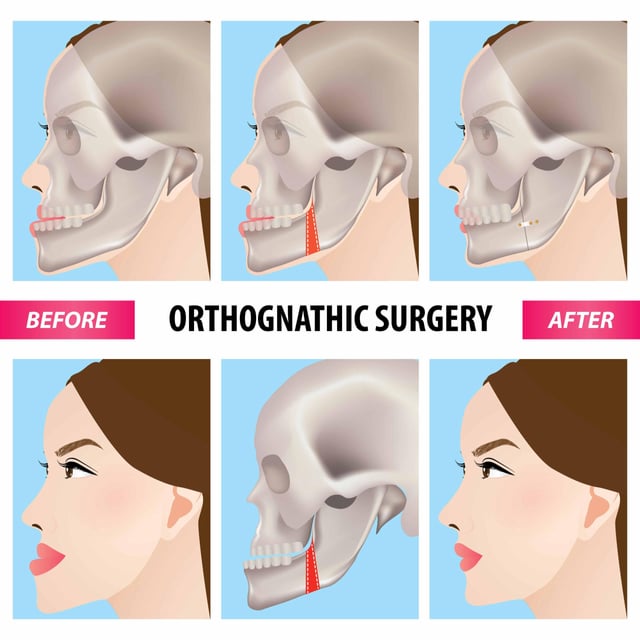 jaw-surgery-orthognathic-surgery-in-sri-lanka-v0-3rqkmlkxb9cf1.jpeg