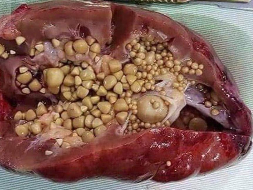 kidneystone_fb.jpg