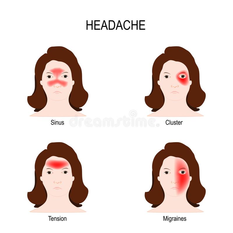 migraine-headache-type-headaches-sinus-result-infections-cluster-short-episodes-severe-pain-te...jpg