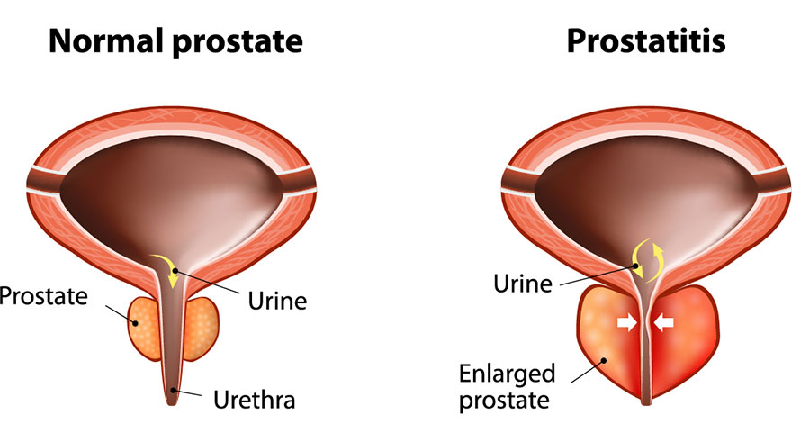 prostitis.jpg