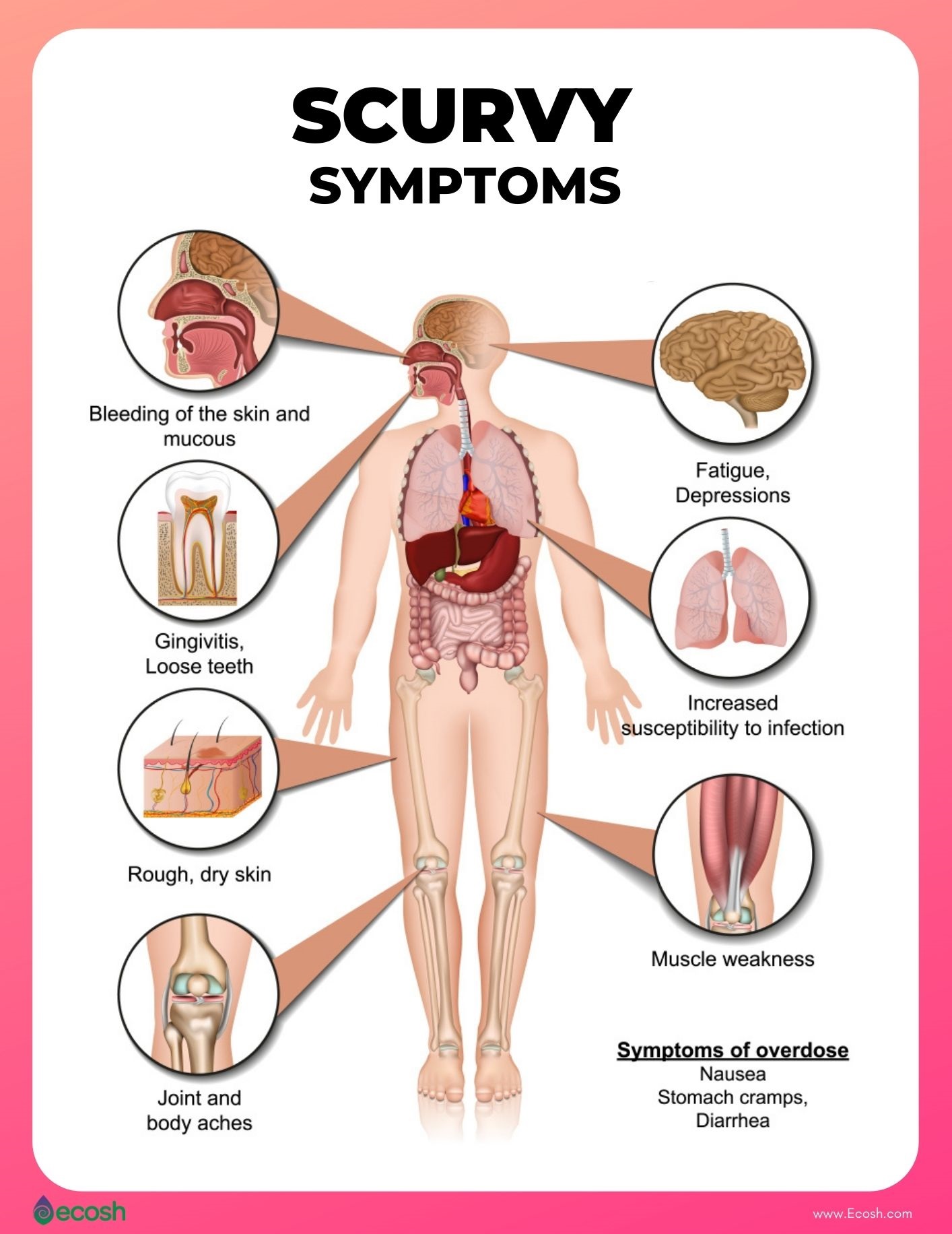 Scurvy_Symptoms_Scurvy_Signs_Vitamin_C_Deficiency_Symptoms.jpg