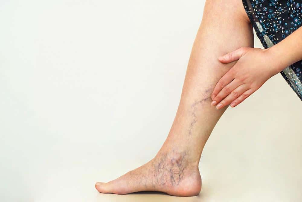 Venous-Insufficiency.jpeg