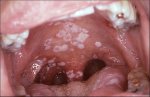 aids-photo-candidasis.jpg
