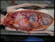 Photo-1-Total-situs-viscerum-inversus.jpg