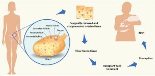 ovarian-tissue-transplant-sgh.jpg