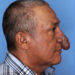 0_Man-with-severely-deformed-nose-who-was-forced-to-wear-face-masks-to-hid-it-gets-miracle-sur...jpg