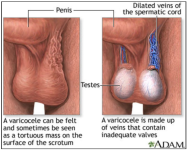 varicocele-and-varicocelectomy.png