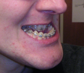 Mandibular_prognathism_pre-surgery.png