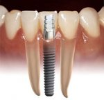 Implant.jpg