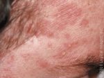 seborrheicDermatitis_167_lg.jpg seborrheicDermatitis_167_lg.jpg