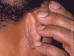 seborrheicDermatitis_2253_lg.jpg seborrheicDermatitis_2253_lg.jpg