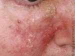 seborrheicDermatitis_2694_lg.jpg seborrheicDermatitis_2694_lg.jpg