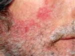 seborrheicDermatitis_43908_lg.jpg seborrheicDermatitis_43908_lg.jpg