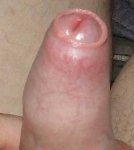 Phimosis.jpg Phimosis.jpg