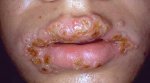 Herpes-around-mouth.jpg