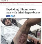 -Exploding_iPhone_leaves_man_with_third_degree_bur.jpg