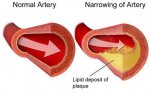 common-causes-of-high-cholesterol__1488161792_58.153.226.192.jpg