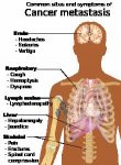 220px-Symptoms_of_cancer_metastasis.svg.jpg