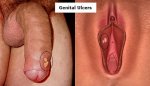 genital-ulcers.jpg