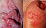 genital-herpes3_orig-768x605.jpg