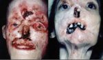 Sipilis Syphilis thewoman.lk 10.jpg