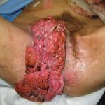Genital warts thewoman.lk.jpg