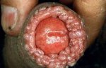 Genital warts thewoman.lk 2.jpg