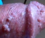 Genital warts thewoman.lk 7.jpg