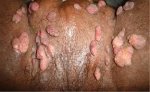 Genital warts thewoman.lk 10.jpg