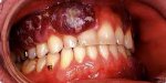 Genital warts thewoman.lk 5.jpg