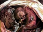 Abortion thewoman.lk 3.jpg
