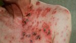 hiv aids thewoman.lk.jpg