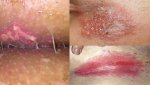 herpes-thewoman.lk-3-768x432.jpg