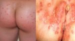 herpes-thewoman.lk_-768x418.jpg