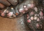 herpes-thewoman.lk-7.jpg