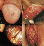herpes-thewoman.lk-6.jpg