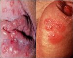 genital-herpes3_orig-768x605.jpg